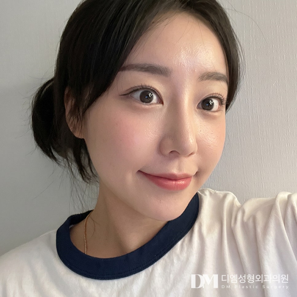 흉터 걱정 줄인 반거상과 안면거상의 차이점은? 관련 이미지 1
