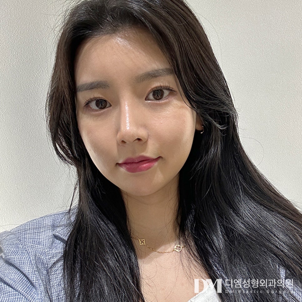 DM Rhinoplasty Before and After Photos: Want to Improve a Flat Side Profile? image 1