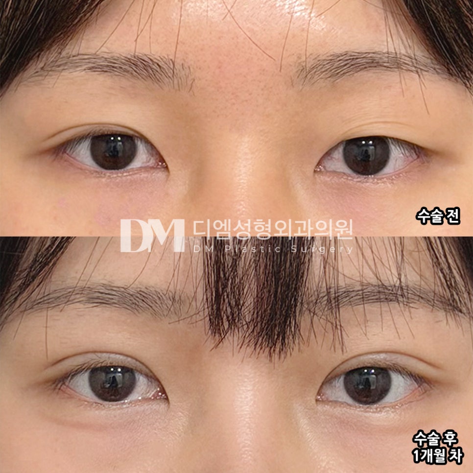 디엠 눈재수술/눈매교정 수술후기, “꼼꼼하고 친절하게 답변해주셔서 좋았어요!” 관련 이미지 2