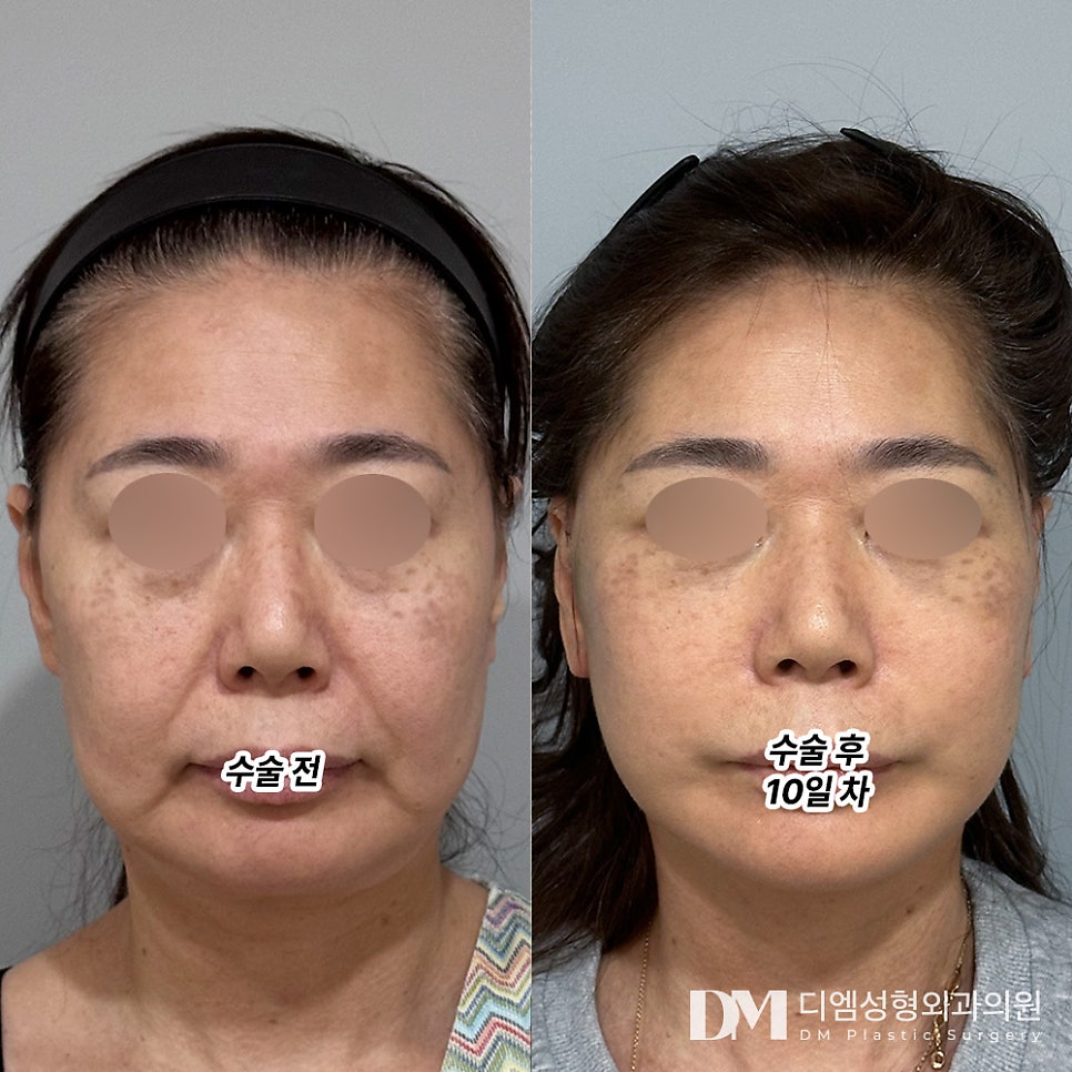 Facelift: What If Deep-Set Wrinkles Are Really Bothering You? image 6