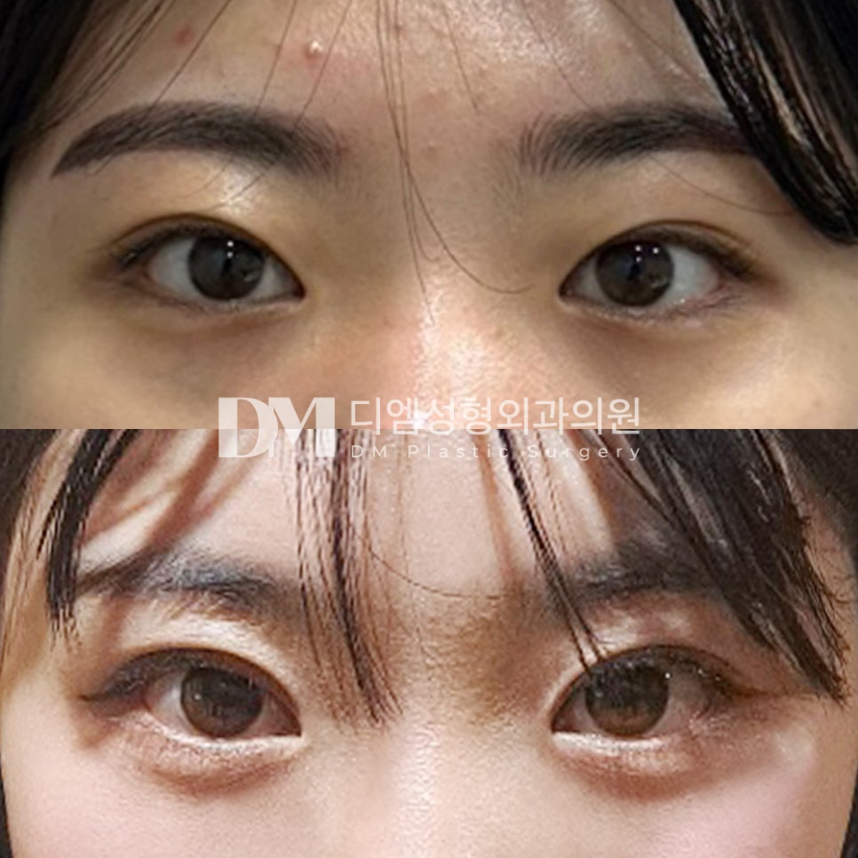 눈성형 후기."붓기도 빨리빠지고 멍이 없어서 만족해요!" 관련 이미지 2