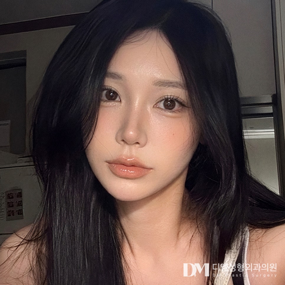 디엠 눈재수술 전후사진, 되찾은 또렷한 눈매! 관련 이미지 1