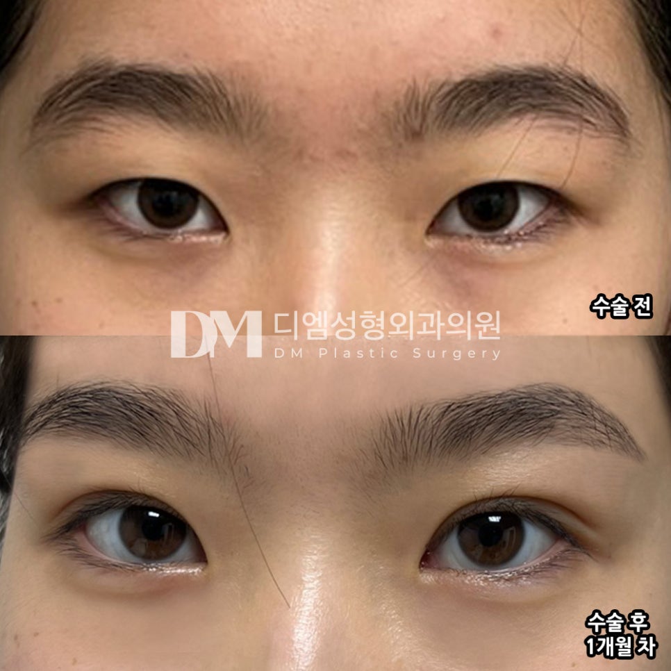 쌍꺼풀수술, 개인별 매력을 살려 관련 이미지 10