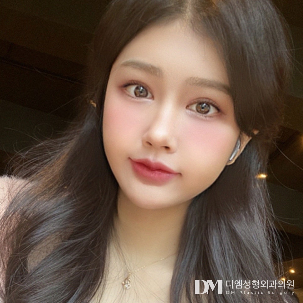 눈매교정 전 필수 체크! 나에게 맞는 수술법은? 관련 이미지 1