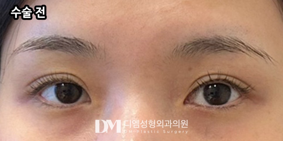 Ppangteuim: If You Want Larger, More Open-Looking Eyes?! image 5