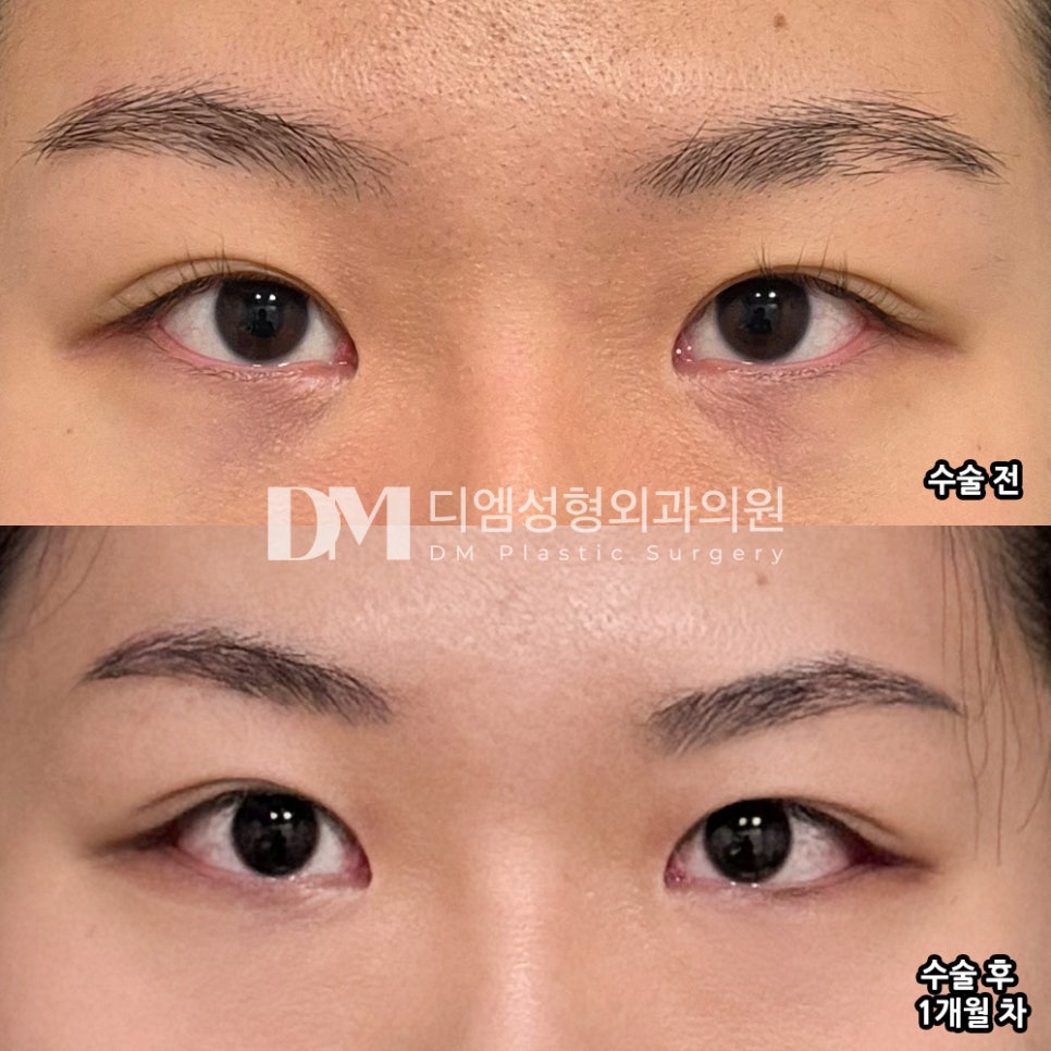 뒤밑트임 후기."꼬막눈 탈출한 거 같아서 너무 만족했어요!" 관련 이미지 2