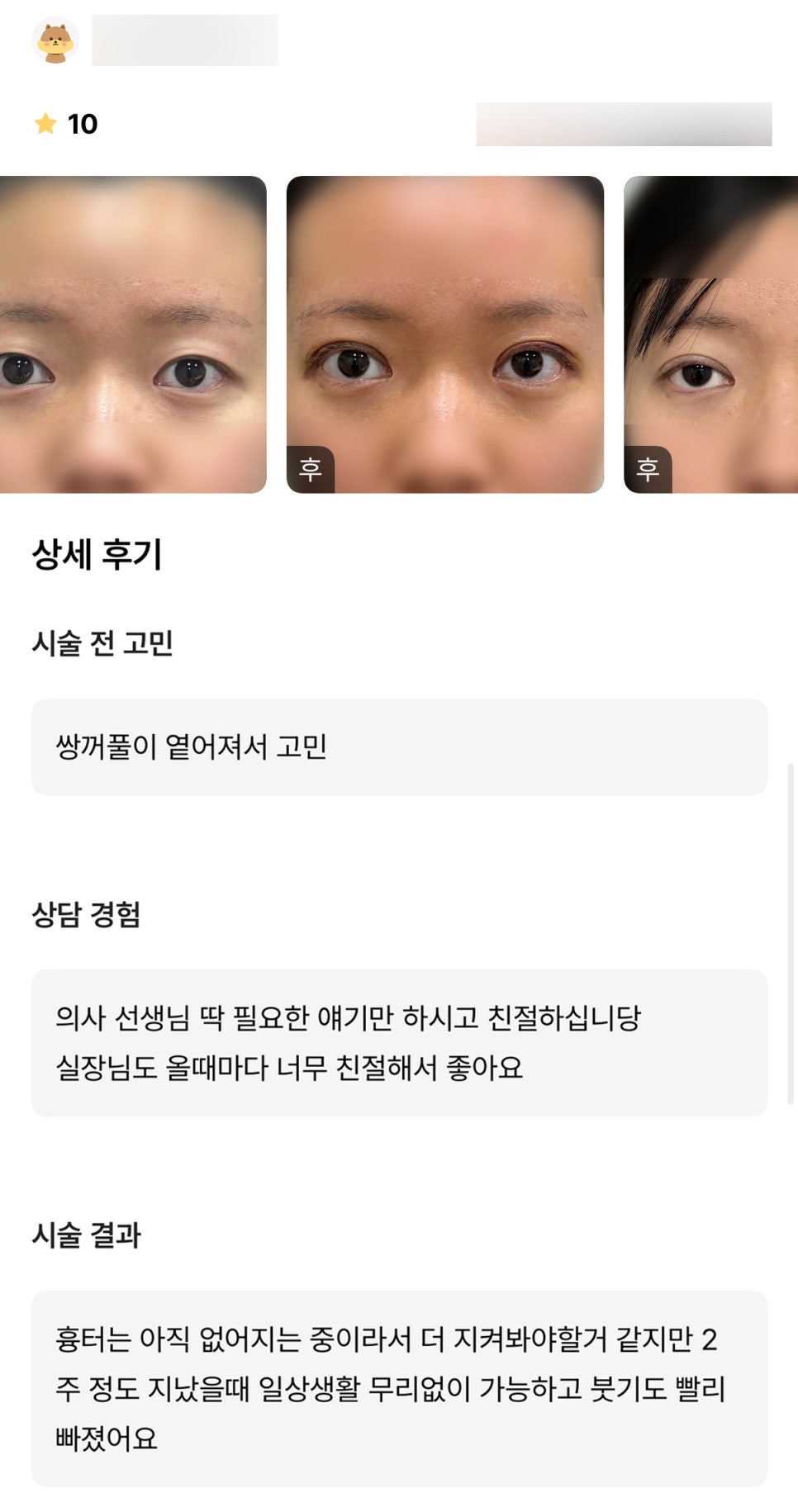 눈재수술 후기."일상 생활 무리 없이 가능하고 붓기도 빨리 빠졌어요!" 관련 이미지 1