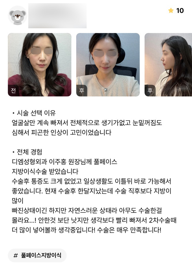 얼굴지방이식 후기."통증도 크게없고 일상 생활도 빨리 가능해서 좋았어요!" 관련 이미지 1