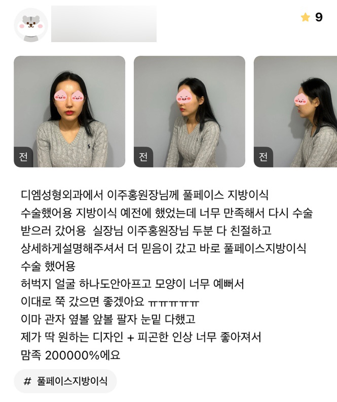 얼굴지방이식 후기."피곤한 인상이 좋아져서 만족이에요!" 관련 이미지 1