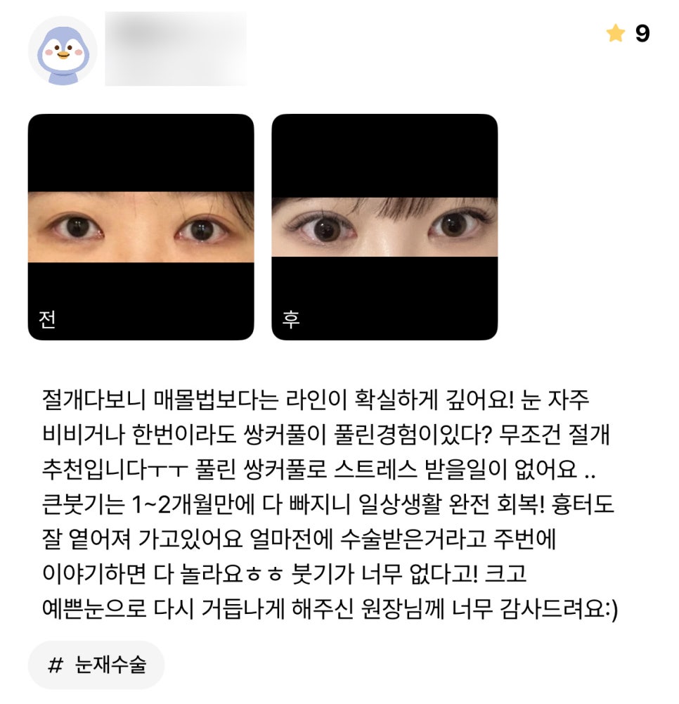 눈재수술 후기."얼마전에 수술한거라고 얘기하면 다들 놀라요!" 관련 이미지 1