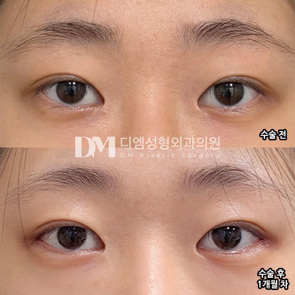 디엠 빵트임/뒤밑트임 후기, “눈이 트인 느낌이 들어 너무 만족 중입니다!” 관련 이미지 2