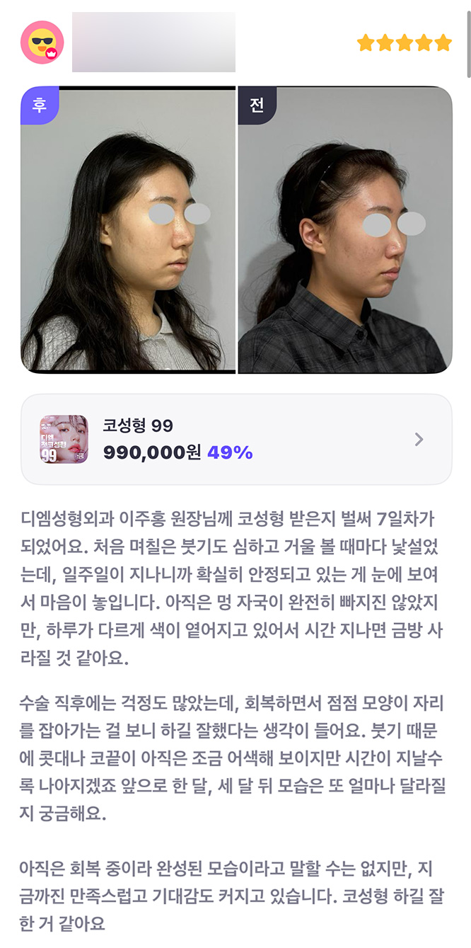 Nose Surgery Review. "So far, I’m satisfied and my excitement keeps growing. I’m glad I decided to get nose surgery!" image 1
