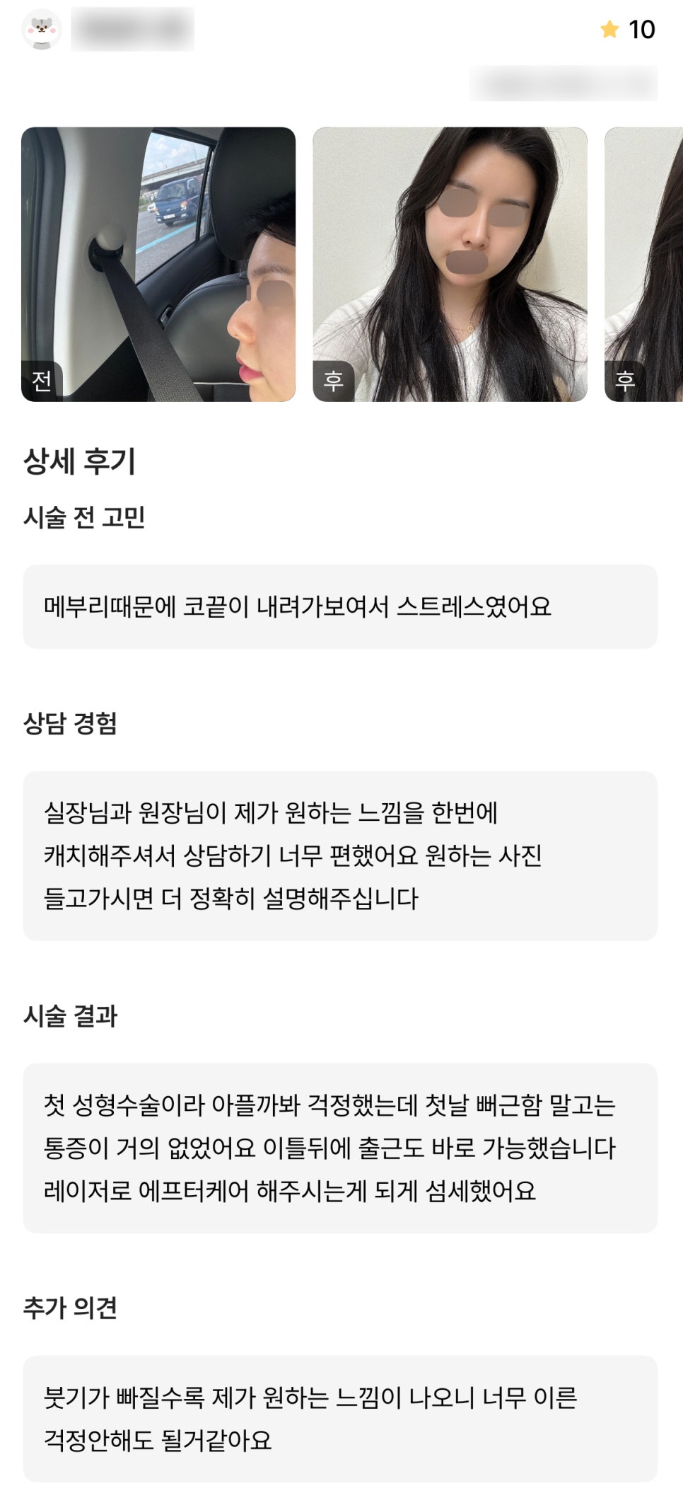 디엠 코성형 후기, &ldquo;붓기가 빠질수록 제가 원하는 느낌이 나와요!&rdquo; 관련 이미지 1