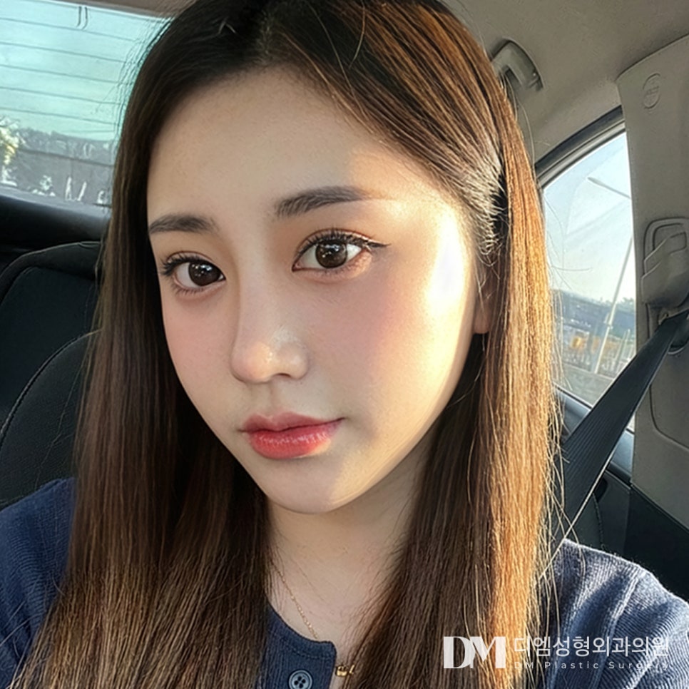디엠 뒤밑트임 전후사진, 가로 길이 확실히 늘려준 비결! 관련 이미지 1
