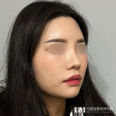 얼굴지방이식 후기."컴플렉스가 개선되어 아주 만족합니다!" 관련 이미지 3