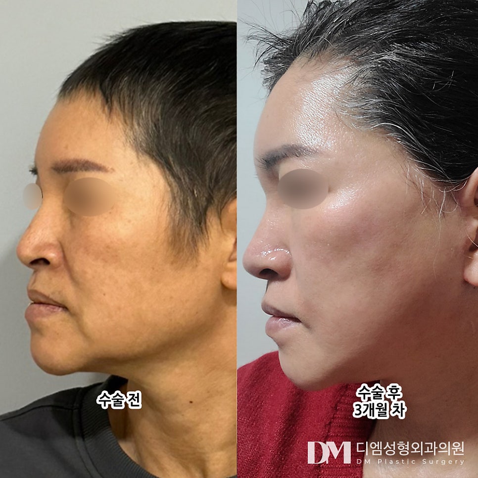 안면거상 후기." 피부 당기는 것도 없고 불편하지 않아서 좋아요!" 관련 이미지 2