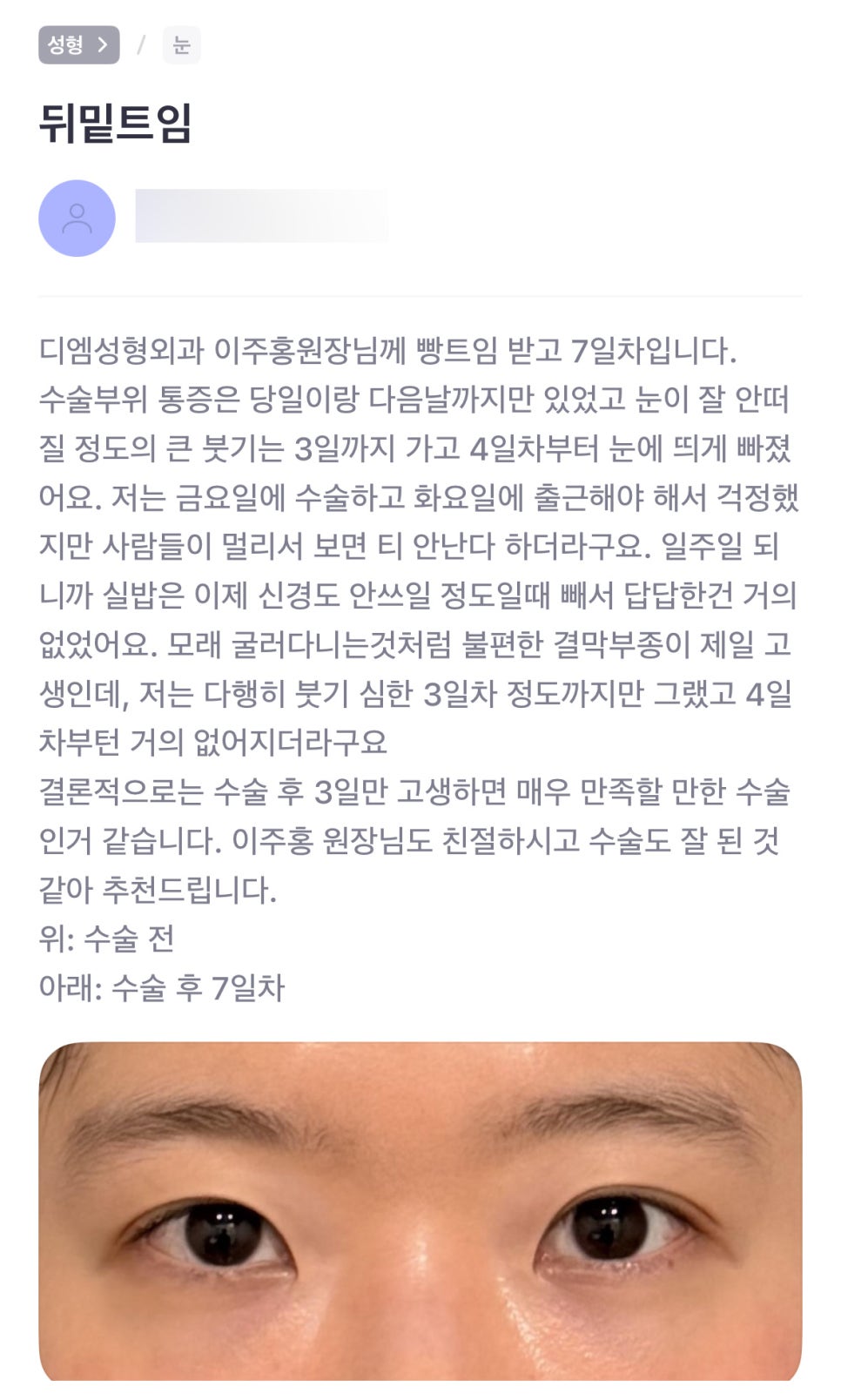 뒤밑트임 후기."원장님도 친절하시고 수술도 잘 된 것 같아 추천드립니다." 관련 이미지 1