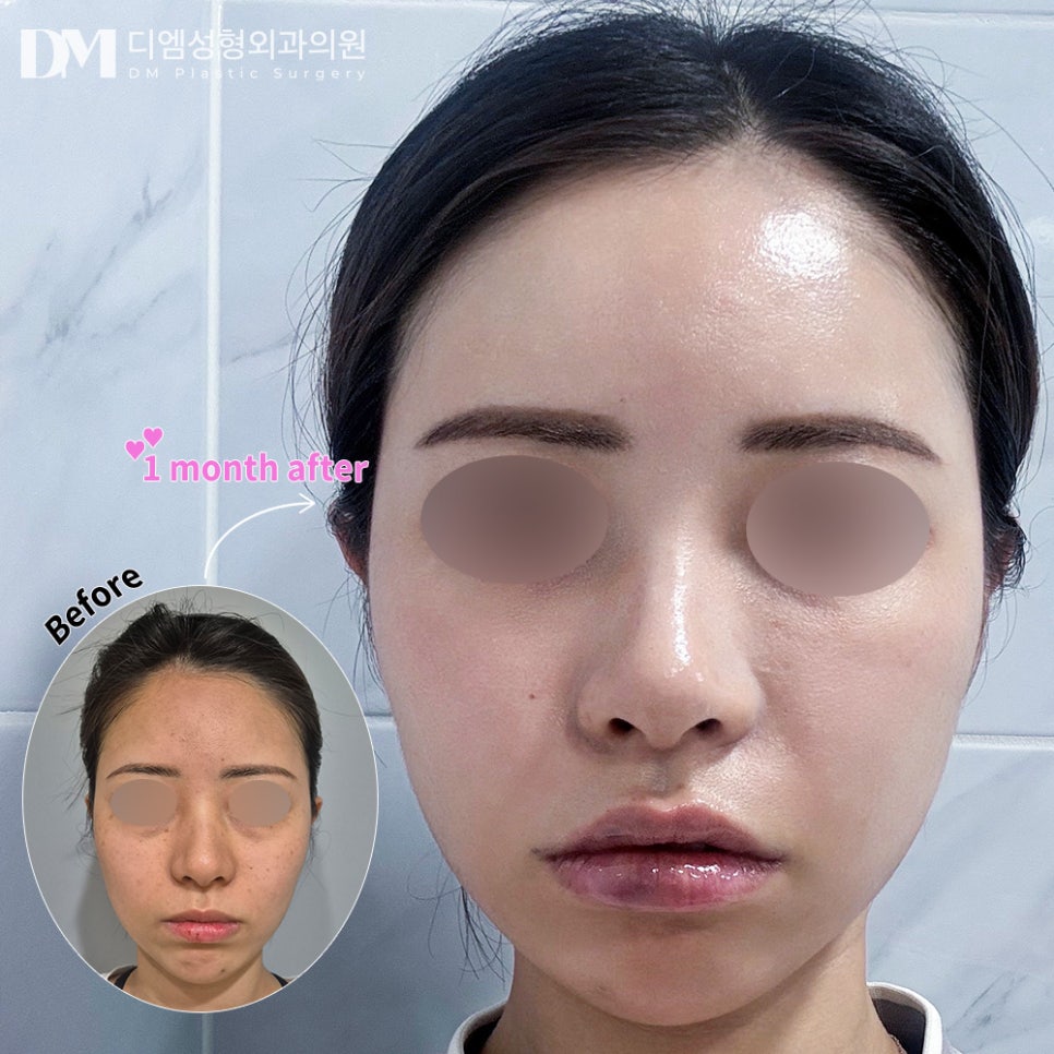 얼굴지방이식 후기."2주 후 부터 얼굴이 자연스러워서 일상 생활 가능한게 좋아요!" 관련 이미지 2