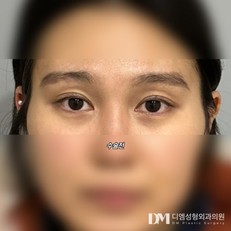 눈재수술 후기."원하는 라인 나와서 너무 만족스럽습니다!" 관련 이미지 2