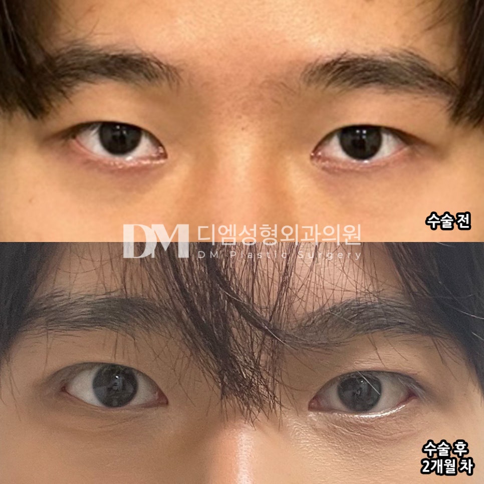눈성형 후기."너무 만족하고 거울볼때마다 짜릿합니다 :)" 관련 이미지 2