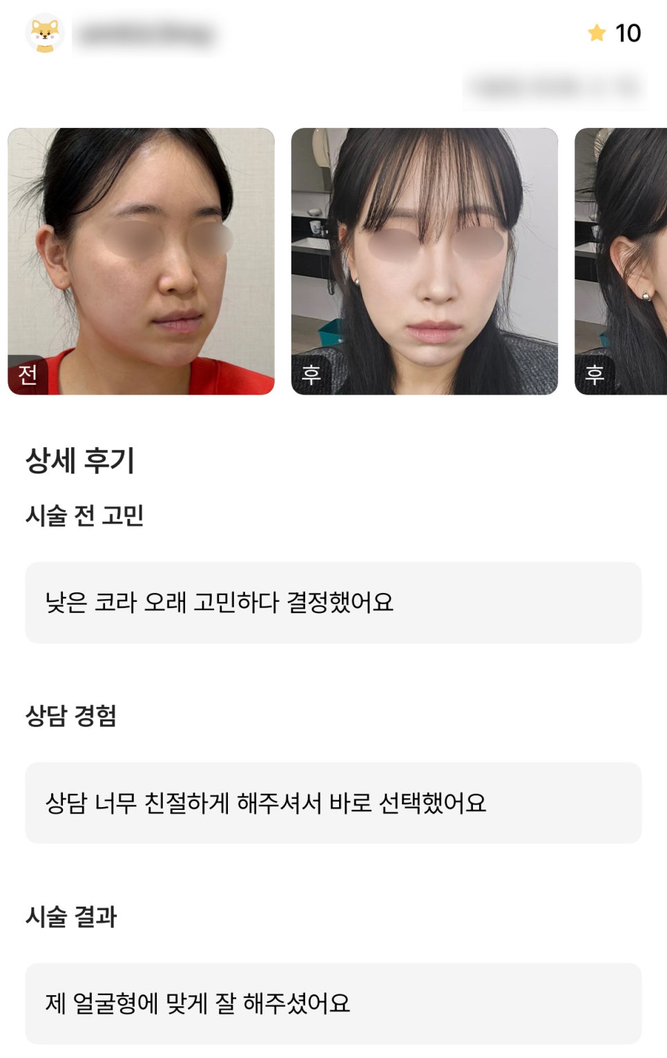 디엠 코성형 후기, &ldquo;제 얼굴형에 맞게 잘 해주셨어요!&rdquo; 관련 이미지 1