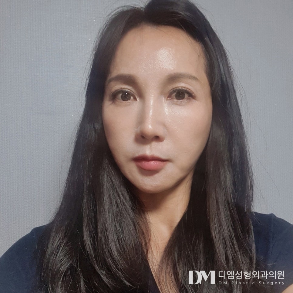 Facelift: Improving Sagging and Wrinkled Skin image 1