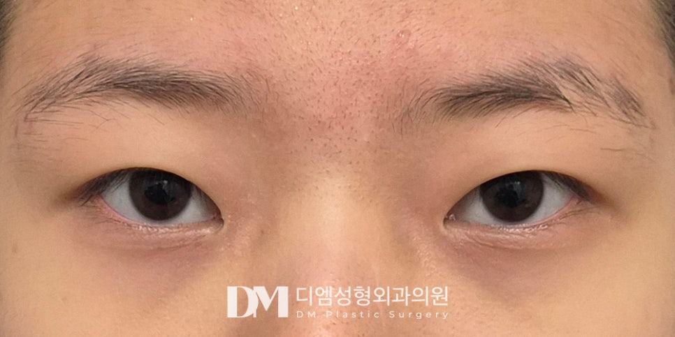 Double-Eyelid Surgery: How to Get It Right the First Time?! image 8