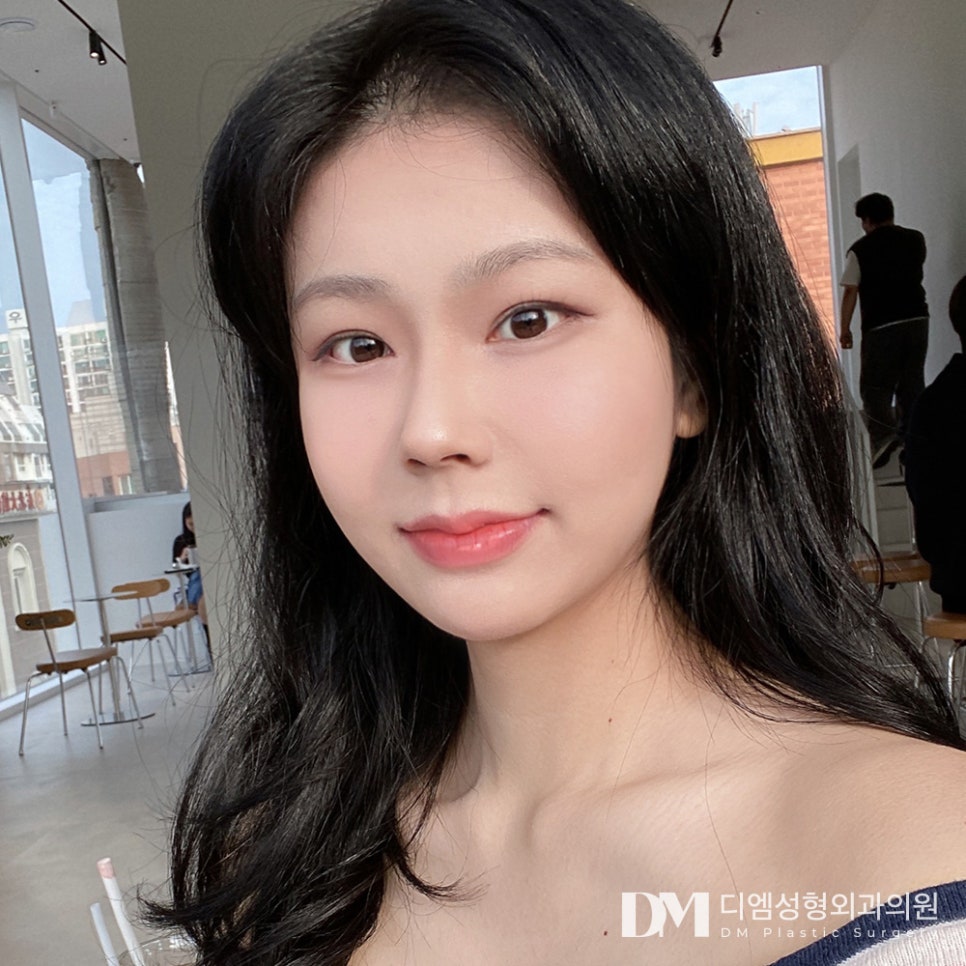 눈 밑 개선으로 환한 동안 인상 되기 관련 이미지 1