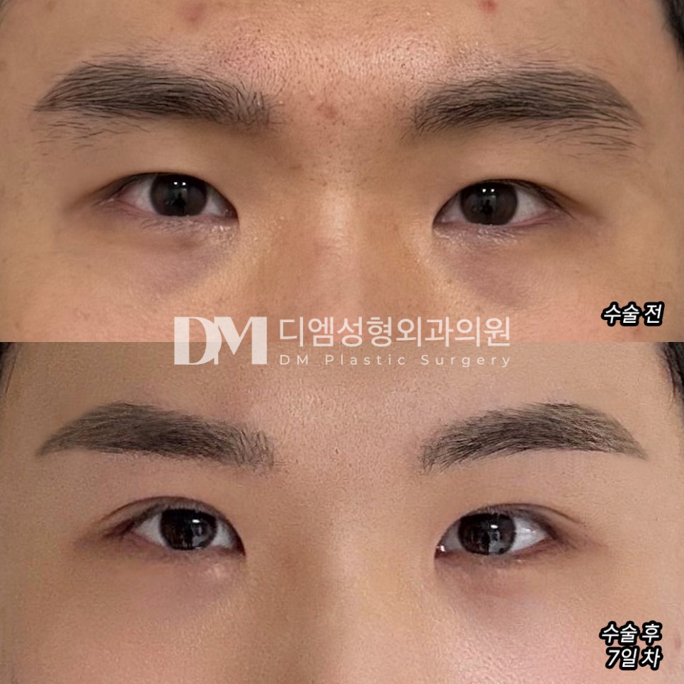 Blepharoplasty Review. "I’m satisfied that I can have clear eyes without having to strain them separately." image 2