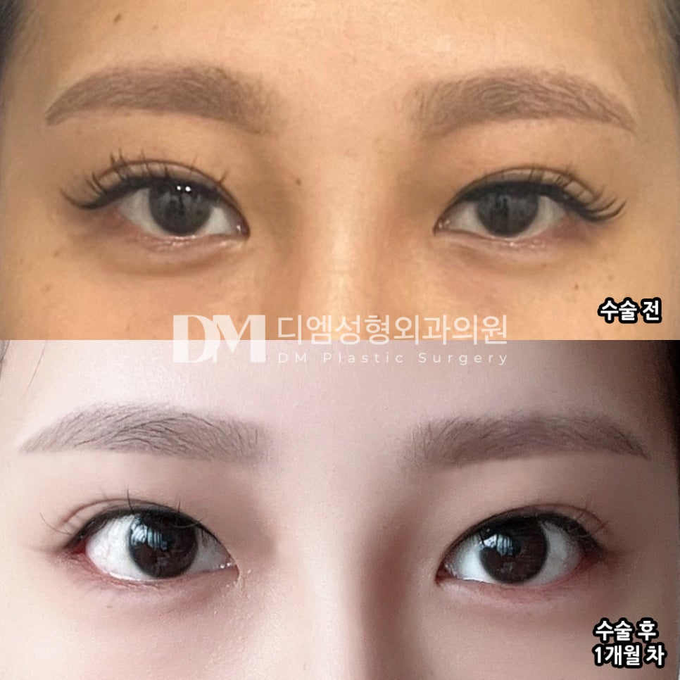 Bbangtwin: Back corner and lower corner eye surgery at the same time! image 5