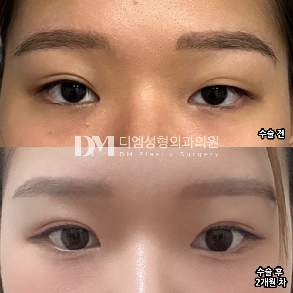 눈재수술 후기."주변에서 눈이 예뻐졌다고 말을 많이 들어요!" 관련 이미지 2