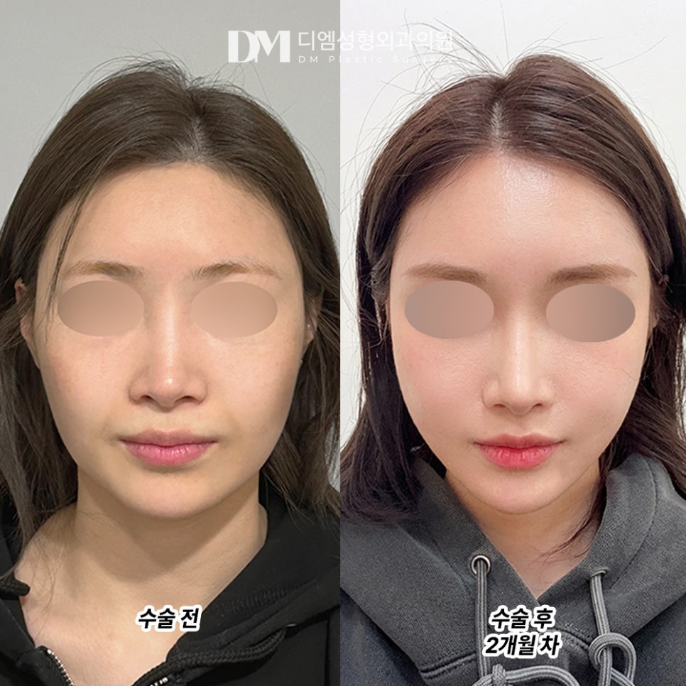 디엠 얼굴지방이식 후기, &ldquo;적당히 차오르면서 인상이 훨씬 부드러워졌어요!&rdquo; 관련 이미지 2