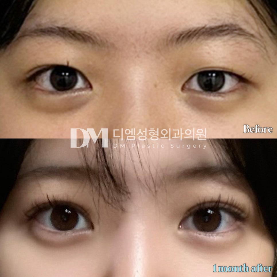 눈매교정, 피곤해보이는 인상 탈출하기 관련 이미지 12