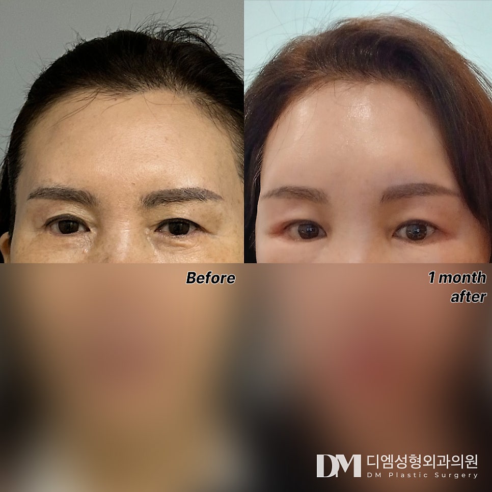 이마거상, 또렷한 눈매 만들기 ! 관련 이미지 7