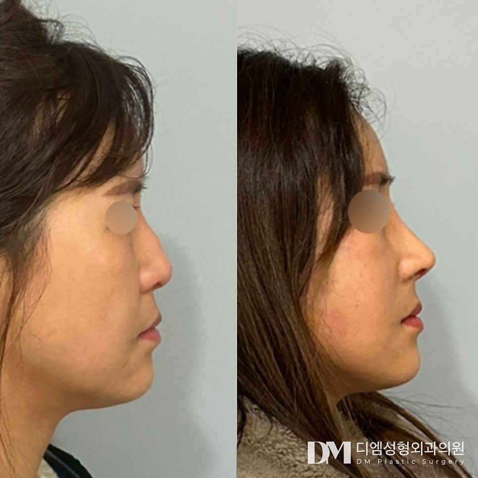 매부리코 , 어느각도에서든 당당한 코 라인으로 관련 이미지 7