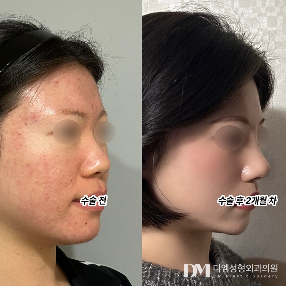 코성형 후기."자연스럽게 콧대가 높아진 것 같아서 만족합니다!" 관련 이미지 2