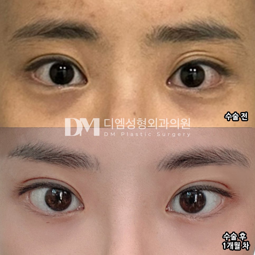 눈재수술 후기."원장님 말씀대로 잘 자리 잡았어요!" 관련 이미지 2