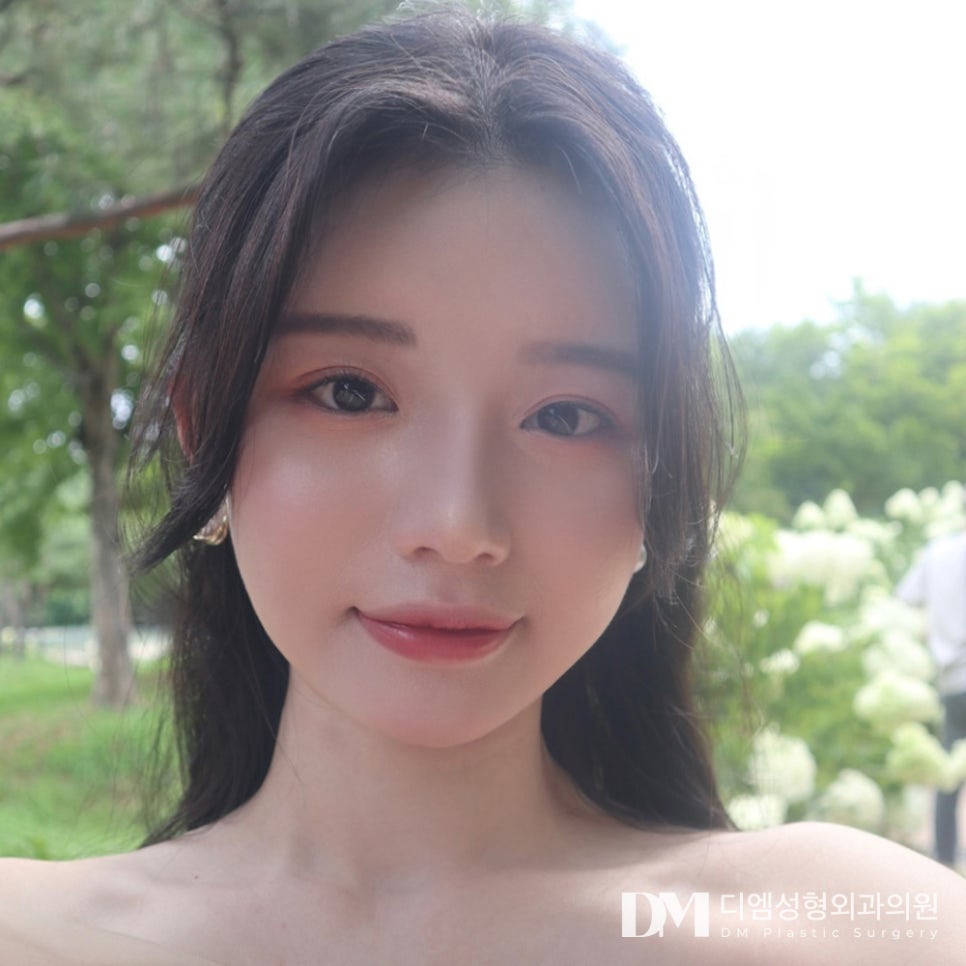 Hump Nose Surgery: Improving Both Appearance and Internal Function! image 10