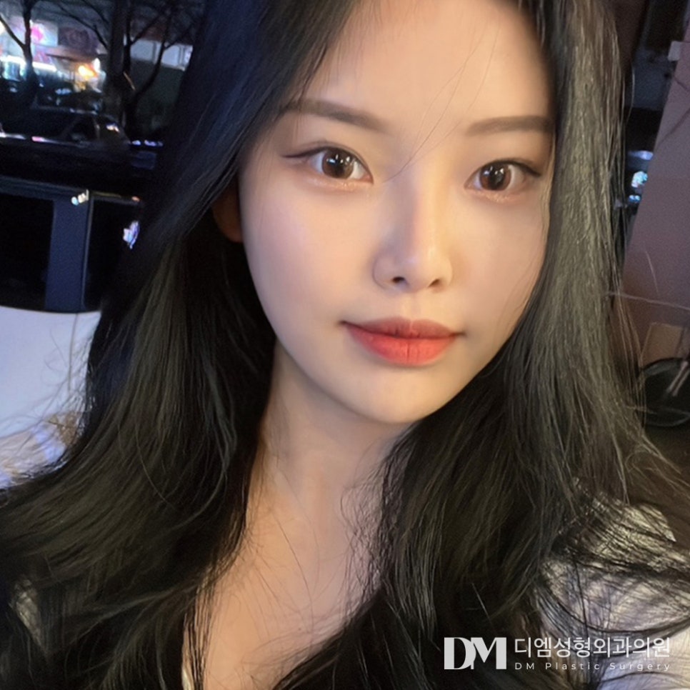 노화로 인해 자연스레 꺼지는 얼굴 볼륨, 얼굴지방이식으로 개선할 때! 관련 이미지 1