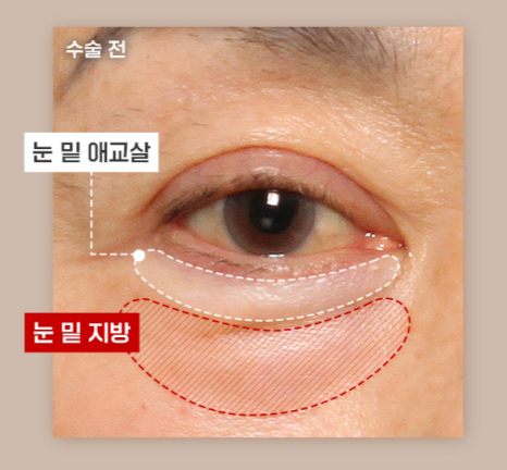 하안검, 밝고 젊어보이는 인상 만들기 관련 이미지 3