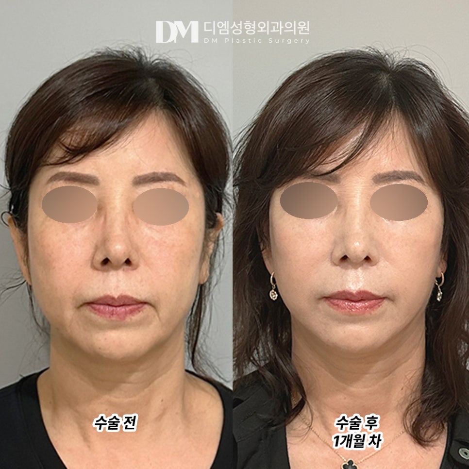 디엠 안면거상 전후사진, 무너진 턱선을 되살리는 핵심은? 관련 이미지 2