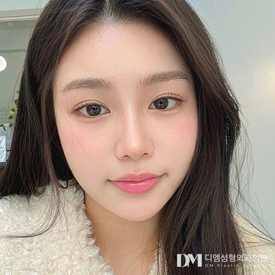 디엠 트임성형 전후사진, 앞과 뒤가 답답해 보이는 눈매 개선 방법은? 관련 이미지 3