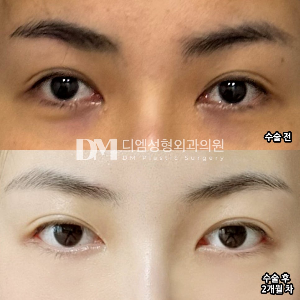Blepharoplasty Corner Release Review. “I like that my eyes became clearer without looking overly dramatic.” image 2