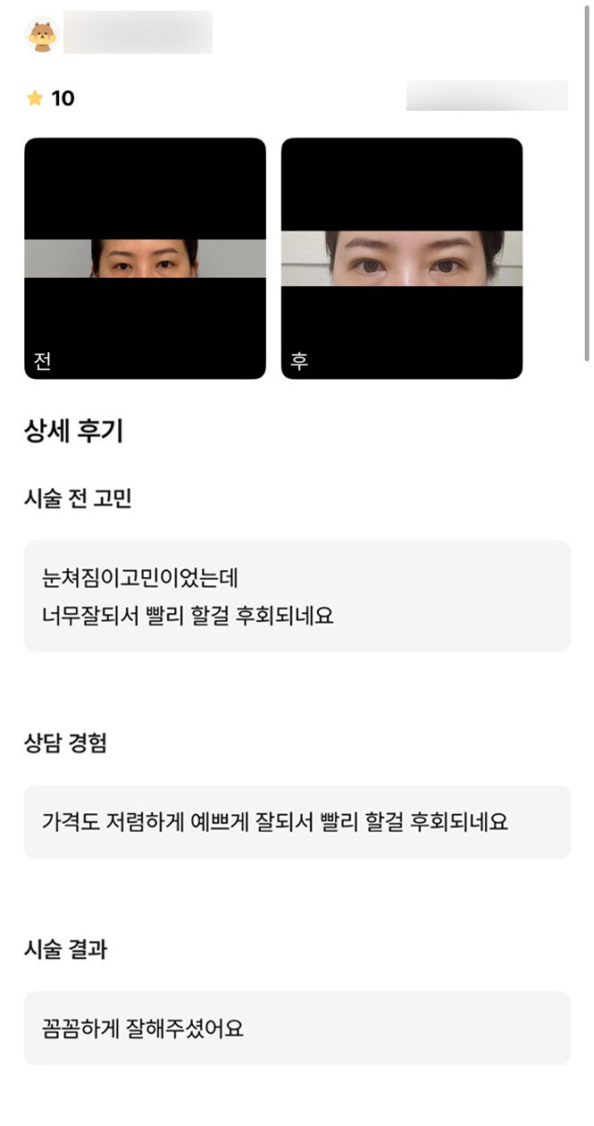 상안검 후기."눈쳐짐이 고민이었는데 너무 잘 되서 빨리 할걸 후회되네요" 관련 이미지 1