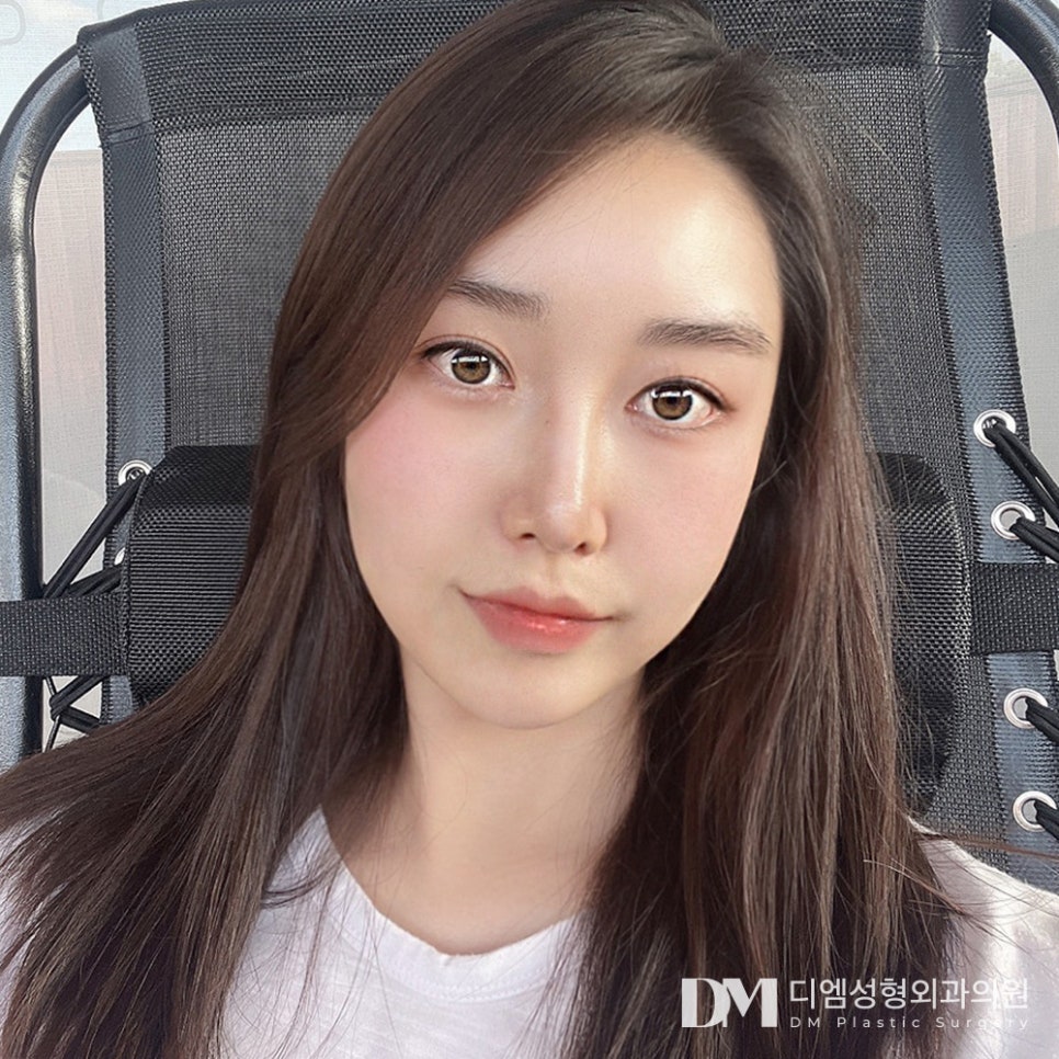디엠 눈재수술 전후사진, 불만족스러운 쌍꺼풀 고민 끝! 관련 이미지 3