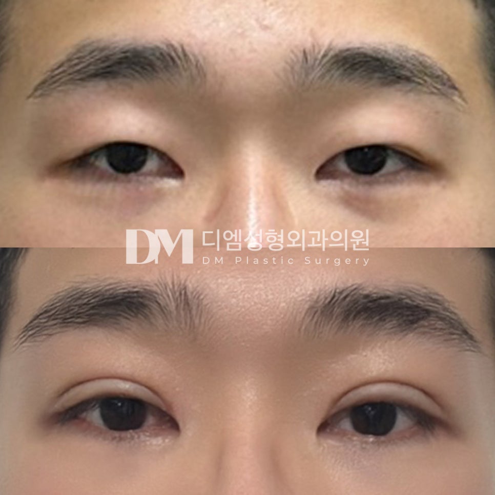 눈재수술 후기."눈이 커지고 또렷해져서 좋아요 ㅎ" 관련 이미지 2
