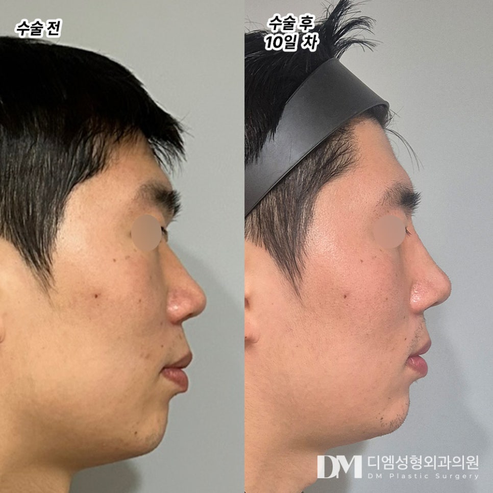 나에게 맞는 높이를 찾아주는 맞춤형 낮은코성형 관련 이미지 8