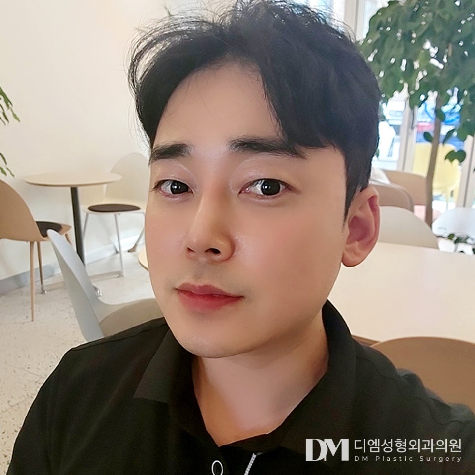 디엠 남자눈매교정/남자눈성형 전후사진, 졸려 보이는 눈이 또렷해지는 변화! 관련 이미지 3