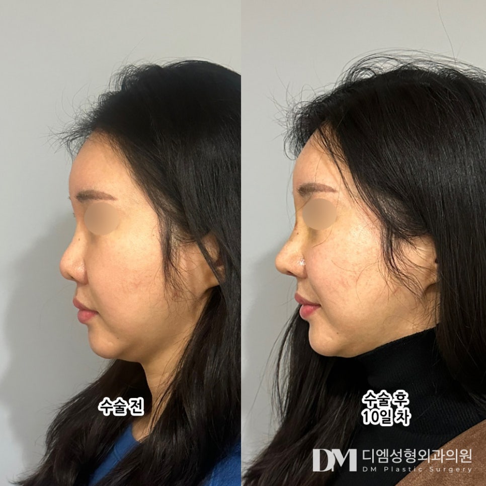 Revision Rhinoplasty Review. “I’m so satisfied because the shape of my nose looks naturally beautiful!” image 2