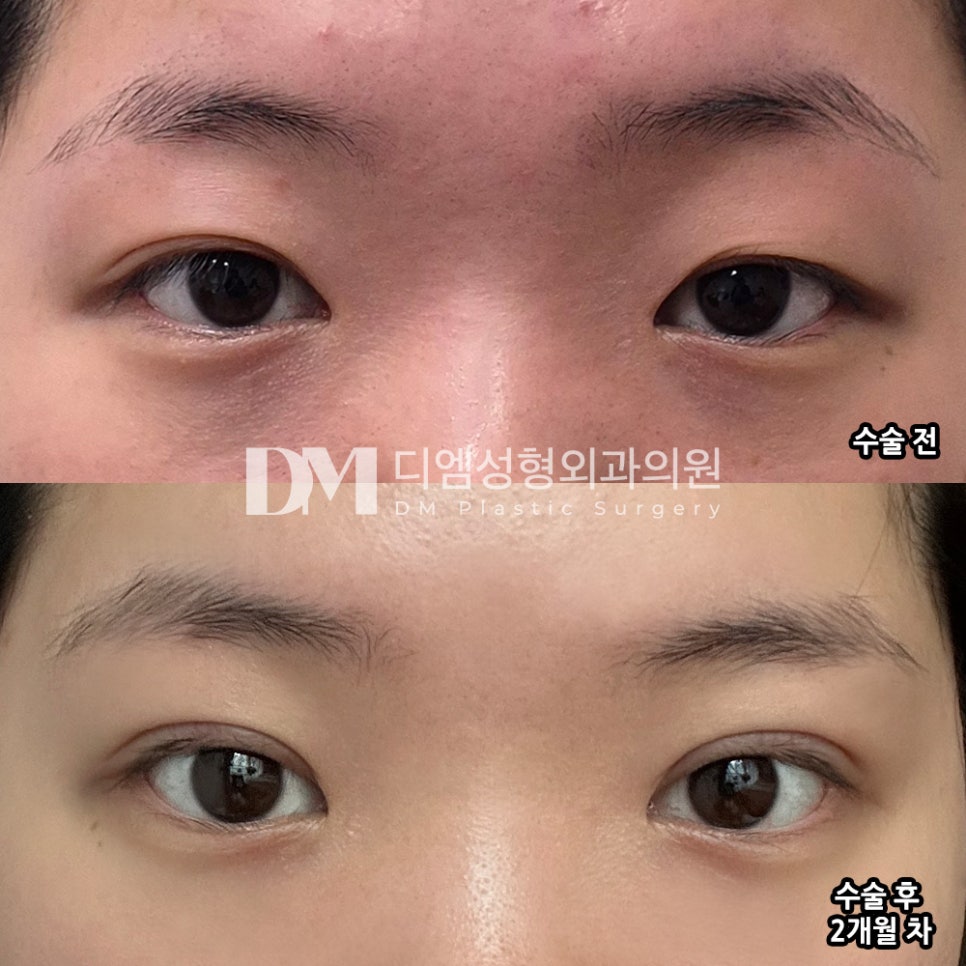 Revision Eye Surgery Review: “I’m so satisfied because I really love the crease!” image 2